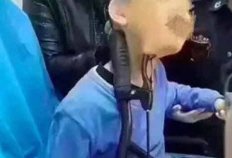 共享单车又出事：天津9岁男孩被车把插入脖子