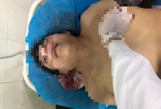 19岁少女隆鼻丧命: 中国每年有2万人被整容毁掉