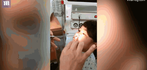 医生从女孩鼻子里取出一条活长虫 妹子一脸淡定