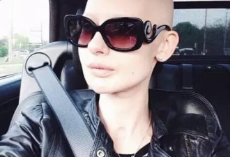 她身患骨癌，被割掉下巴和头发却活成最美超模