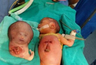 孪生兄弟发育不全 印女婴天生多个头