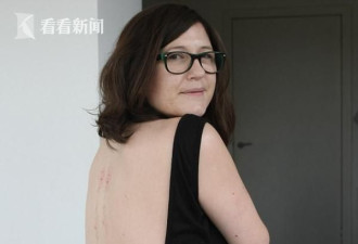 想起来都疼，英国女子为治病每周被蜜蜂蜇30次