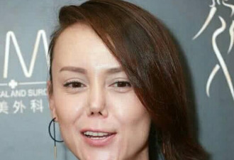 她摔了一跤后，鼻梁断了，整容失败星途尽毁...
