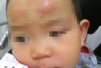 18月大女婴使用退烧贴额头过敏 厂家正在调查