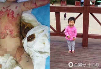 两岁女童掉入开水盆 大面积烫伤 爷爷自责绝食