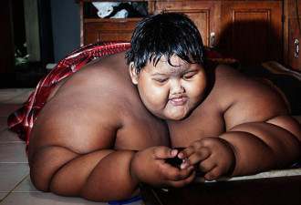 世界最胖男孩重380斤 做缩胃手术有望减掉200斤