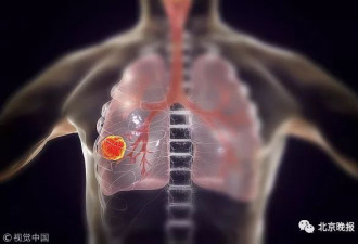 国家癌症中心报告：肺癌居恶性肿瘤发病第一位