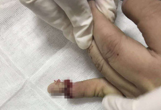 两夫妻吵架，妻子生生咬断丈夫一截手指