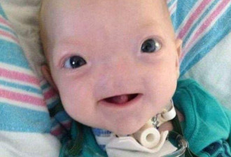 美无鼻2岁男童去世 被称奇迹宝宝生前超可爱