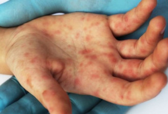 BC卫生局警报：麻疹有新病例