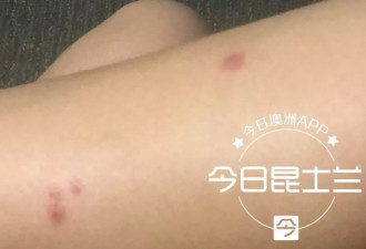 中国留学生被"不明毒虫"咬伤 伤口发红寝食难安