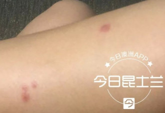 中国留学生被&quot;不明毒虫&quot;咬伤 伤口发红寝食难安