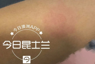 中国留学生被&quot;不明毒虫&quot;咬伤 伤口发红寝食难安
