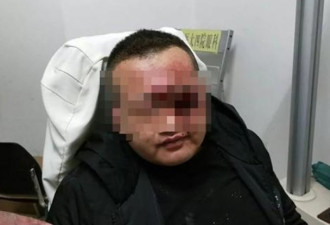 参加祖父80大寿宴会，惨被礼炮炸爆眼球