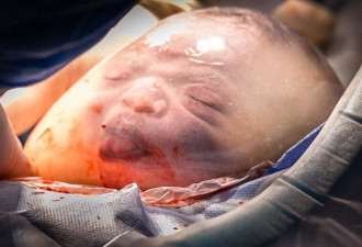 十万分之一的罕见：巴西水泡宝宝照片遭疯传！
