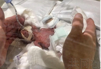 全球最小男婴从日本庆应大学医院出院仅 268 克