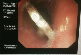 老人验证硬币是否被宝宝吞下 自吞硬币食管被卡