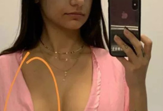 姑娘做整形手术 看比赛被球击中后胸竟“爆了”