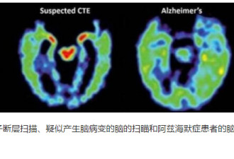 老年痴呆：人生重大打击让大脑老化4年