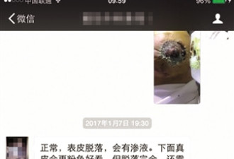 女子隆胸后胸部坏死 主刀医生疑为口腔医生