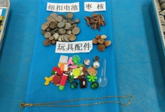 孩子吞下过的物件：图钉电池硬币磁铁啥都有