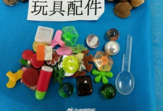 孩子吞下过的物件：图钉电池硬币磁铁啥都有