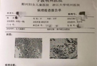 她多年头痛 竟是因为有东西在脑袋里“挖隧道”