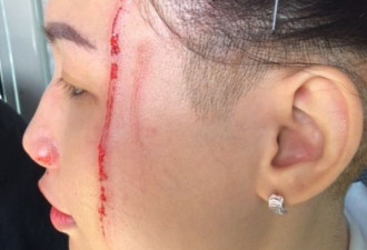 17针！澳洲华人大妈遭暴打 血肉模糊 皮开肉绽