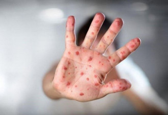 加州200人疑接触麻疹 医院警告全美已现387例