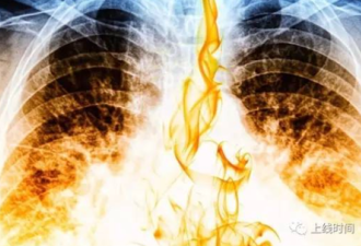 恶性肿瘤居北京市民死因首位 肺癌发病率排第一
