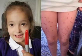 英国6岁小女孩为逃避考试全身画满“水痘”...