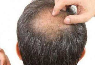 2亿中国人脱发，男性秃头的面积等于1个广州