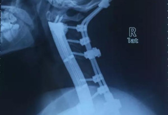 世界首例:用钛合金3D打印置换患者全颈椎椎体
