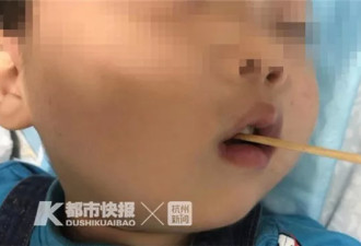 3岁男孩被连夜送来杭州，竹签从嘴巴直插脑干