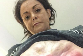 命悬一线！英国女子剖腹产伤口爆裂，肠子流出