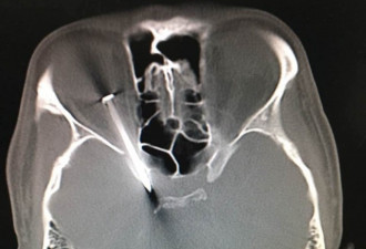 5厘米长钉子插穿眼球 距颈内动脉仅几毫米