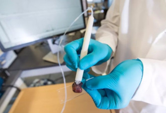 癌症检测笔10秒钟可以识别癌细胞组织