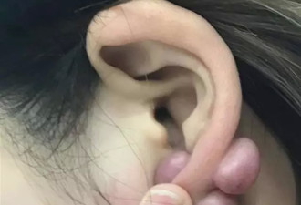 女孩双耳1年内长出6个肉疙瘩，罪魁祸首竟是…