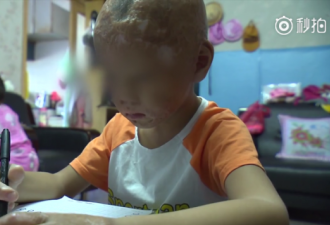 温州一毁容幼童想上学 父亲写求助信被挨个拒绝