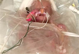 美孕妇患癌为胎儿拒化疗 产后母女相继离世