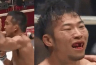 日本选手比赛中遭遇暴力肘击 牙齿全碎满嘴淌血