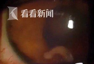少年眼睛钻进一条虫 钻透视网膜游来游去
