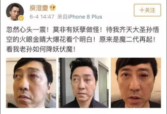庾澄庆“血眼”吓懵网友 医生却说这病很常见？