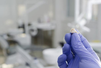开发“牙齿粉碎机”：获取智齿中的干细胞