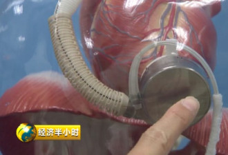 中国研制全磁悬浮人工心脏手术 重量不到180克
