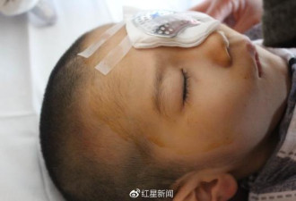 6岁男童遭继母毒手75%颅骨缺损 已接受眼部手术