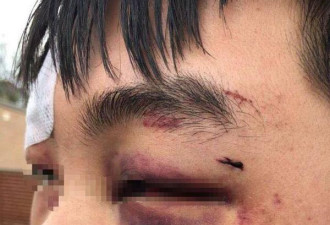 中国留学生遭围殴被斥滚回中国 澳警方拘捕3人