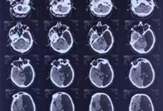 CT显示左脑是空的！靠半个大脑存活了60年