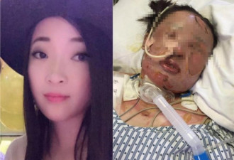 女孩烧伤生命垂危 母亲去医院途中车祸身亡