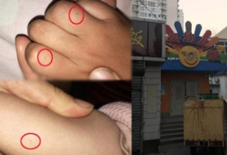 北京再传幼儿园针刺事件：鉴定是干性湿疹